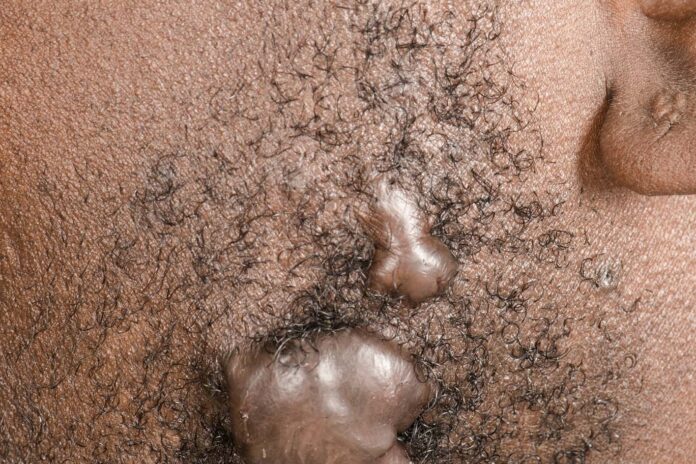 Seek Treatment for a Keloid